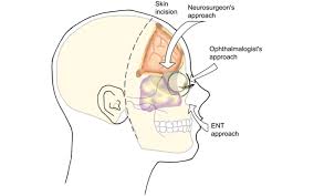 ENT Surgeon For Skull Base Surgery